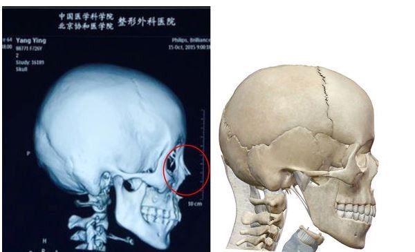 整形醫師拿Baby的電腦斷層與正常鼻骨比對，發現鼻背上多了凸起物。（圖擷自pixnet）