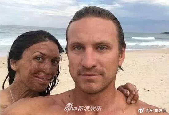 被火紋身毀容 28歲女模找到真愛