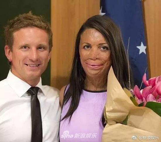 被火紋身毀容 28歲女模找到真愛