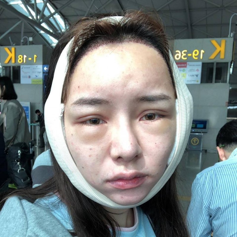 赴韓整容失敗？ Kiwebaby頂豬頭臉說...