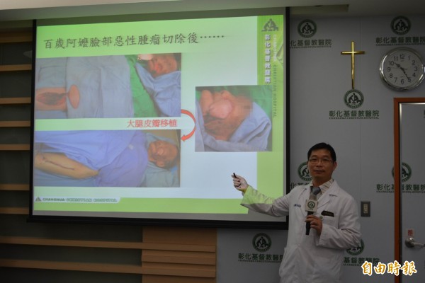 彰基整形重建外科醫師周惠能為百歲阿嬤臉頰腫瘤局部麻醉後切除並移植,成功變臉。(記者湯世名攝)