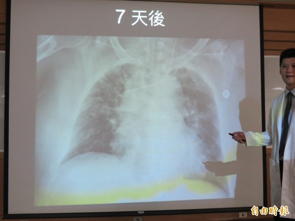 婦人接受葉克膜治療七天,肺功能恢復。(記者蘇孟娟攝)