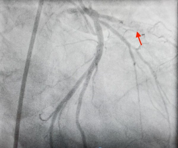 這名泰國醫生冠狀動脈左前降支裝支架處再狹窄，血流阻塞無法流通。（記者蔡淑媛翻攝）    