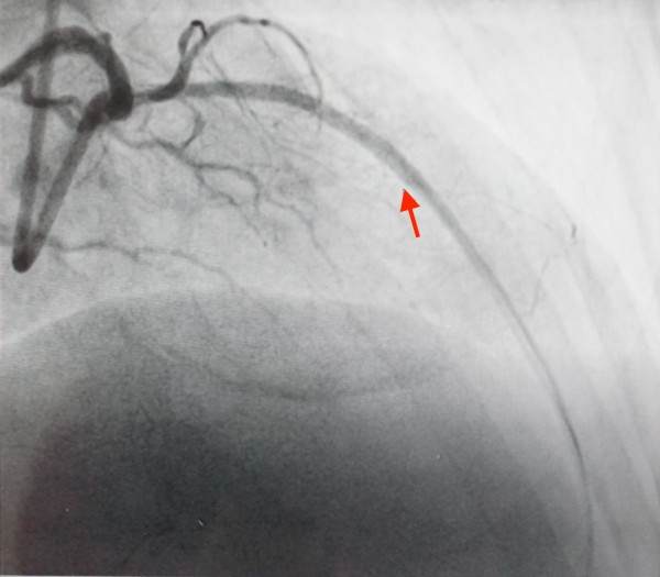 這名泰國醫生冠狀動脈左前降支裝支架處再狹窄，緊急心導管手術放置支架打通，血液能流通。（記者蔡淑媛翻攝）          