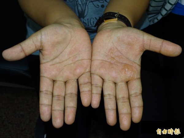 汗皰疹長在手、腳掌或指頭側邊的小水泡，但不是流汗造成。（記者蔡淑媛翻攝）                          