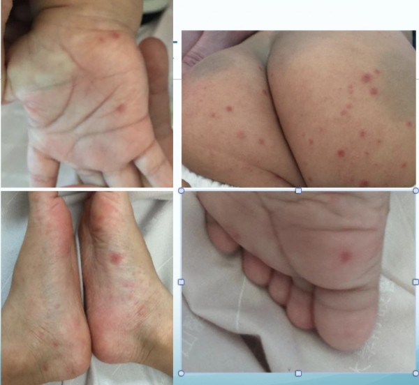 腸病毒紅疹一般長在手、足、口呈現點狀小疹子或小水泡。（記者蔡淑媛翻攝）