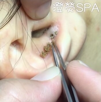 SPA美容師這樣慢柔清耳朵粉刺…影片紅到國外。（翻攝「澄熒SPA」臉書）