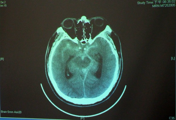 唐男的腦部已出現蜘蜘膜下腔出血，即影像中白白如細紋的部位。（記者陳鳳麗翻攝）