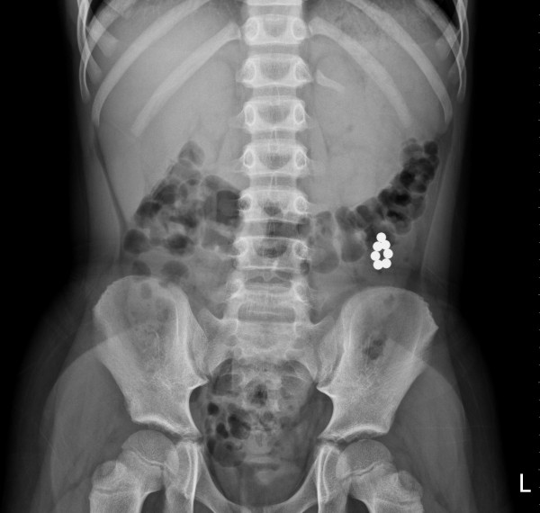 10歲男童先後誤吞7顆巴克磁球，X光檢查7顆磁球均聚集在大腸。（記者方志賢翻攝）