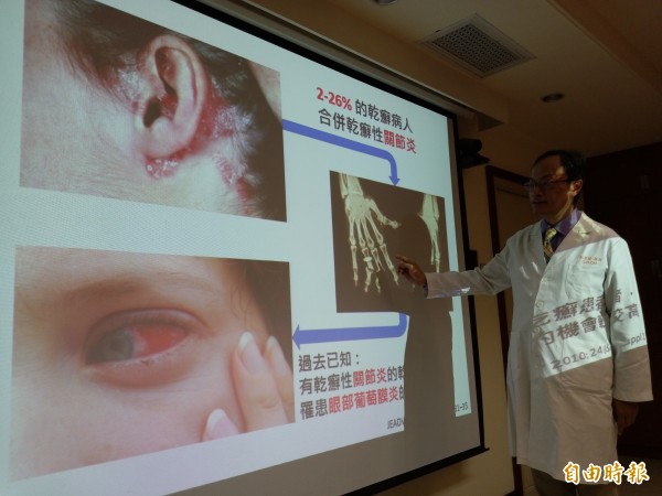 紀景琪說,同時具有重度乾癬及乾癬性關節炎的患者,發生眼部葡萄膜炎的機會最高、是正常人的2.4倍。(記者吳亮儀攝)
