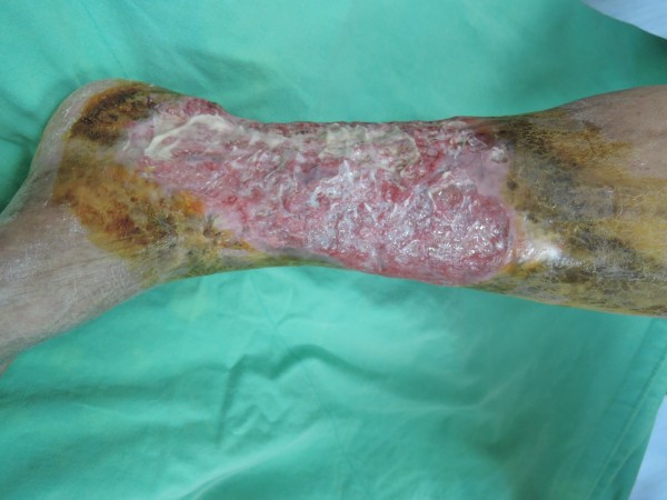 患者30年前被狗咬傷左小腿，傷口反覆發炎潰爛，擴大蔓延到整個小腿，傷口流膿、流血。（圖郭耀仁提供）