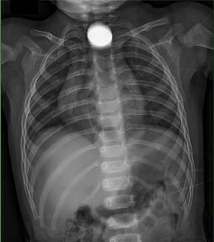 男童照了Ｘ光，發現一個圓形金屬物卡在食道，最後以麻醉插管保護呼吸道，才利用消化道內視鏡取出金屬物，一看竟是一枚5元硬幣。（醫院提供）