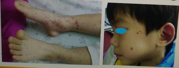 罹患類過敏性紫斑症的四歲郭姓男童下肢有明顯紅疹。(記者王俊忠翻攝) 罹患類過敏性紫斑症的四歲郭姓男童下肢有明顯紅疹。(記者王俊忠翻攝)
