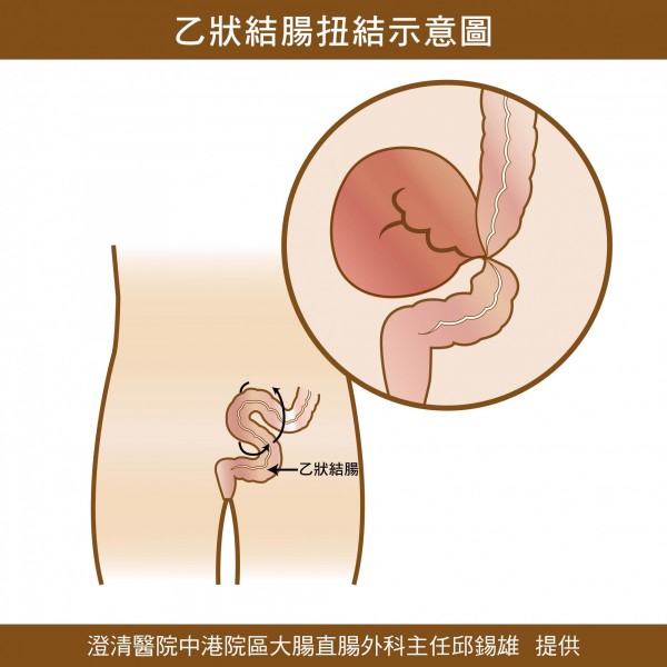 阿伯便祕劇烈腹痛,原來「腸」處過人,腸打結作崇。(記者蘇孟娟攝)