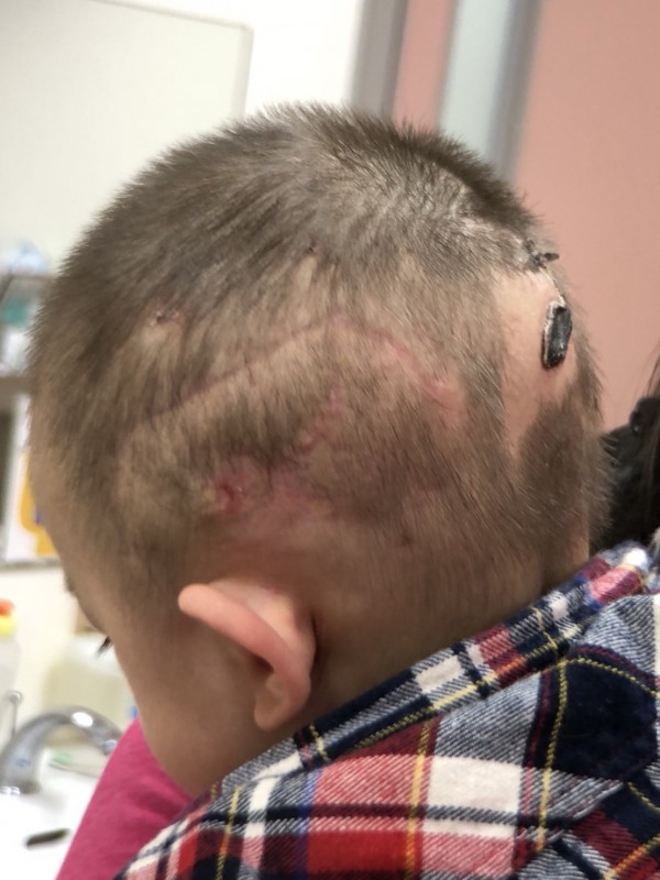 被比特犬攻擊男童,術後醫治恢復良好。(記者陳賢義翻攝)