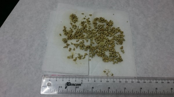 醫師手術從老翁膀胱內取出300顆結石。(圖由醫院提供)