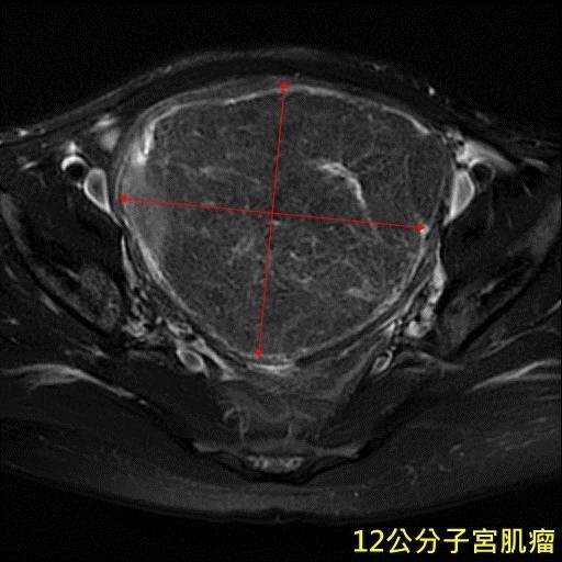 台中一名比丘尼近半年來肚子漸漸隆起、腹痛，檢查發現竟長了一個12公分大的子宮肌瘤。（記者陳建志翻攝）