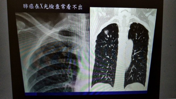 低劑量電腦斷層照出右肺上側有白點結節(右圖箭頭指處);X光(左圖)則拍不出結節點。(記者王俊忠翻攝)