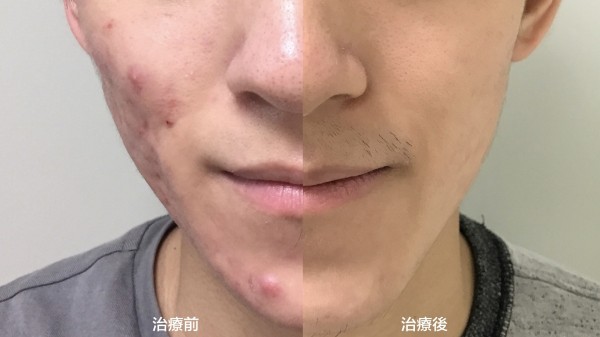18歲患者罹嚴重青春痘,比對治療前後大幅改善。(記者蔡淑媛翻攝)