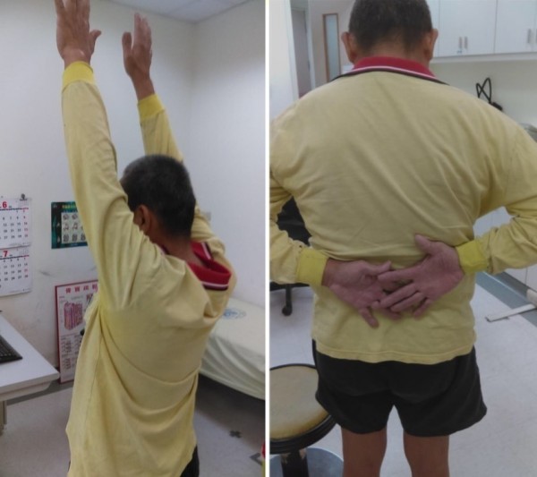 旋轉肌袖破裂以手術治療後,手臂動作2到6個月就能恢復正常。(記者詹士弘翻攝)