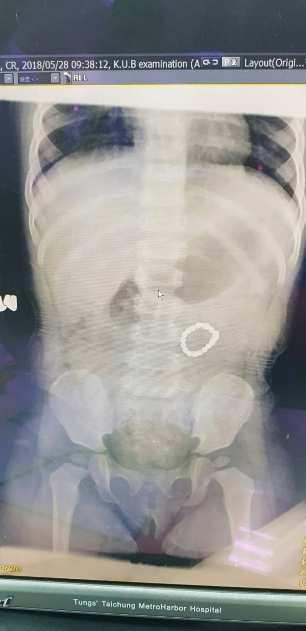 X光照出女童腸道童有巴克球。(記者張軒哲翻攝)