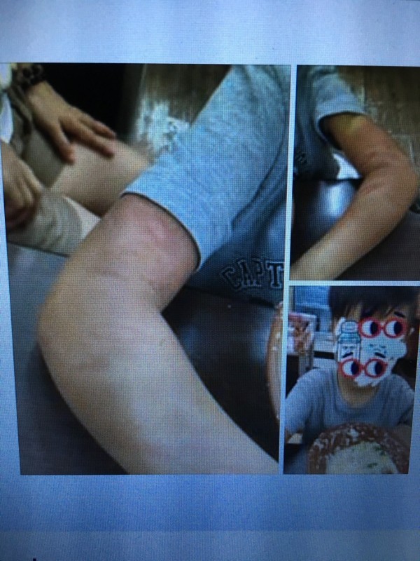 王童被母親打傷,手部有嚴重瘀傷。(記者林嘉東翻攝臉書汐止集團)