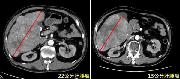 台北一名陳姓老伯,3個月前檢查發現長出22公分大肝腫瘤(左),經亞大醫院以標靶藥物配合「標靶光子刀」治療後,腫瘤已明顯縮小(右)。(記者陳建志翻攝)