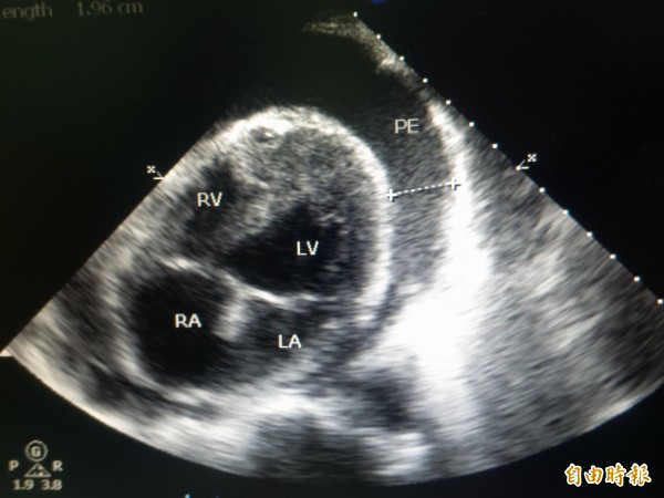 新竹68歲張姓榮民因心悸及呼吸困難緊急就醫，經心臟超音波檢查， 醫生發現他的心臟被大量心包膜積水壓迫。（記者廖雪茹攝）