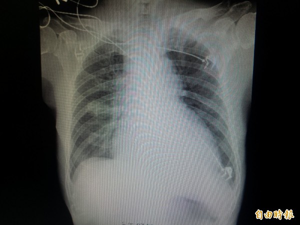 張姓患者到仁慈醫院急診就醫，Ｘ光片顯示心臟明顯擴大，氧氣指標下降，當晚馬上入住加護病房。（記者廖雪茹攝）