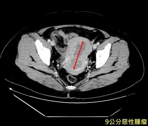 台中一名許姓婦人陰道異常出血,檢查後發現已經長了一個9公分大的子宮內膜癌。(記者陳建志翻攝)