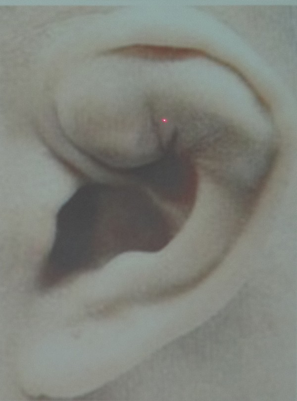 耳廓假性囊腫(雷射紅點所指處)如未妥善治療,病情惡化嚴重恐會影響聽力。(記者王俊忠翻攝)