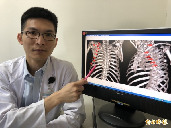 骨科部醫師楊鎮源表示,透過3D胸廓重組影像可見患者15處骨折。(記者歐素美攝)