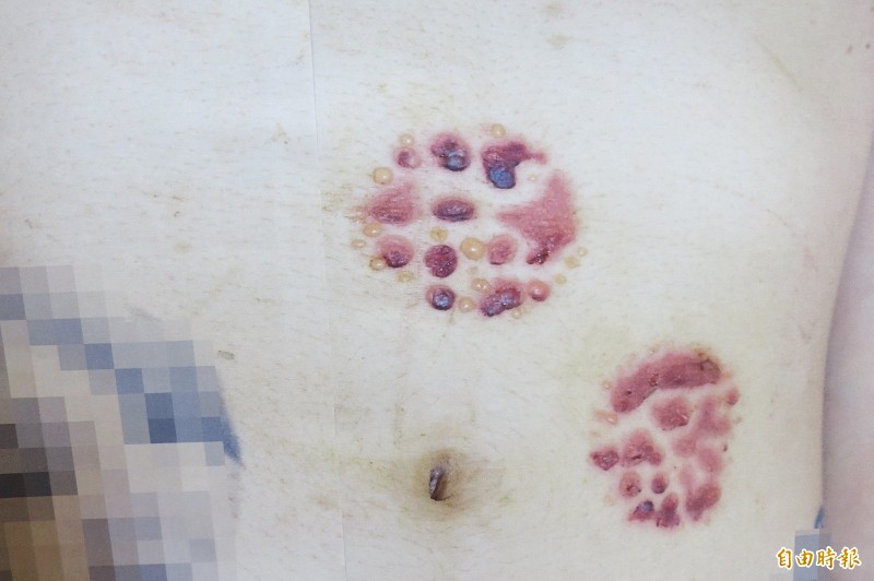 妙齡女拔罐不慎睡著一拔3小時,醒來身上多處滿佈水泡圓疤。(記者蘇孟娟攝)