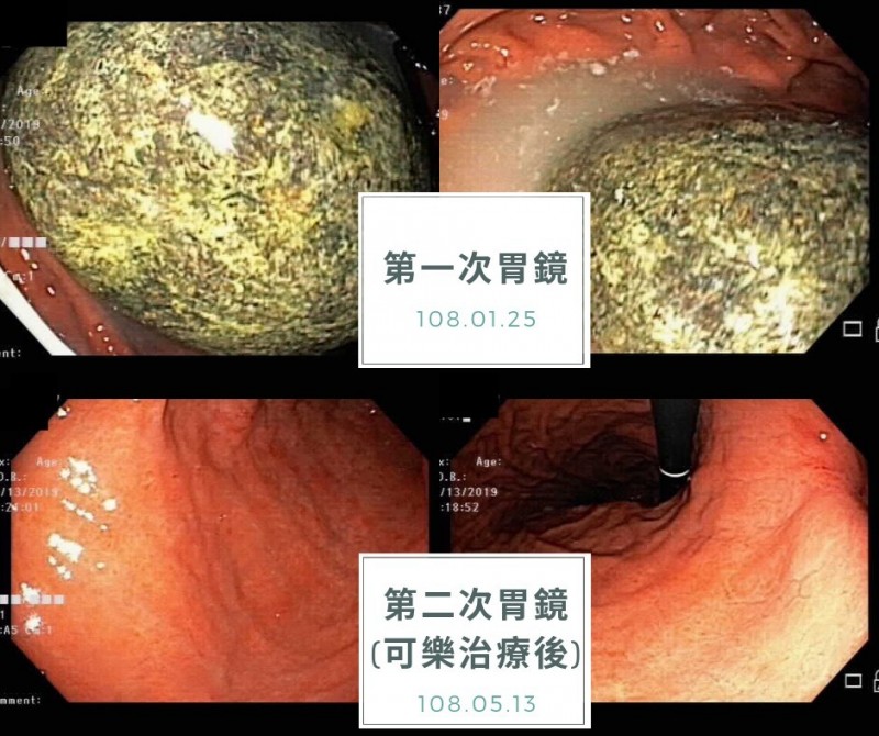老翁胃裡的這顆胃糞石直徑超過10公分,幾乎跟壘球一樣大,他聽醫師建議喝可樂,成功溶解掉了。(圖由平安葉治威聯合診所提供)
