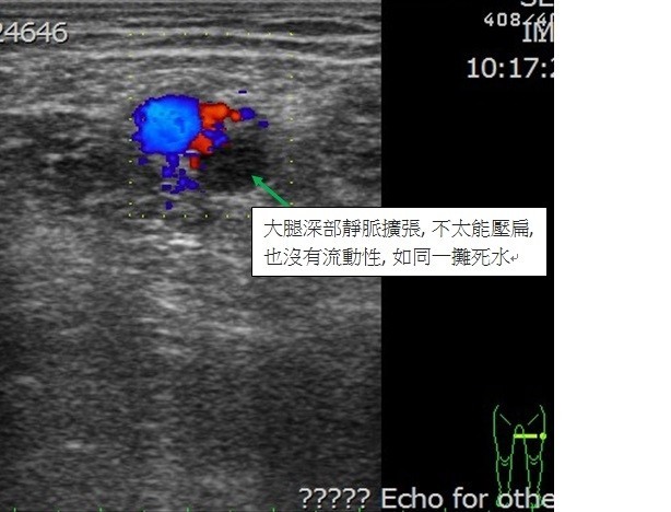 陳翁大腿大腿深部靜脈擴張,不太能壓扁也沒有流動性,如同一攤死水(彰化醫院提供)