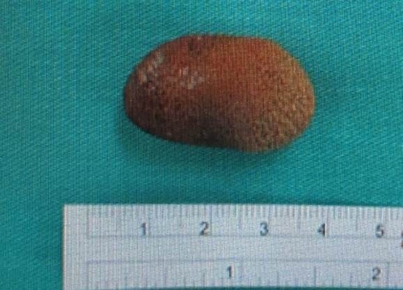 張姓老婦腎盂巨石引發泌尿道反覆感染,經醫師李明輝利用不同切口腎盂取石術,取出約4公分的結石。(記者張勳騰翻攝) 張姓老婦腎盂巨石引發泌尿道反覆感染,經醫師李明輝利用不同切口腎盂取石術,取出約4公分的結石。(記者張勳騰翻攝)