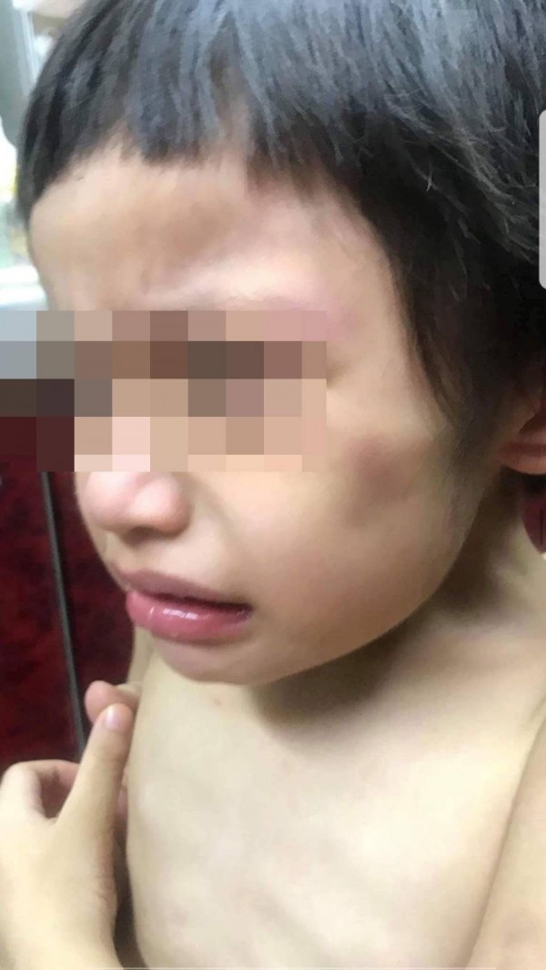 3歲男童被打得全身是傷且骨瘦如柴。（取材自臉書）