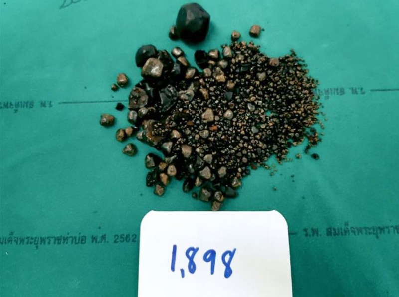 泰國廊開府(Nong Khai)一家醫院在60歲女性患者的膽囊裡發現1898顆大大小小的膽結石!(圖擷取自醫院臉書)