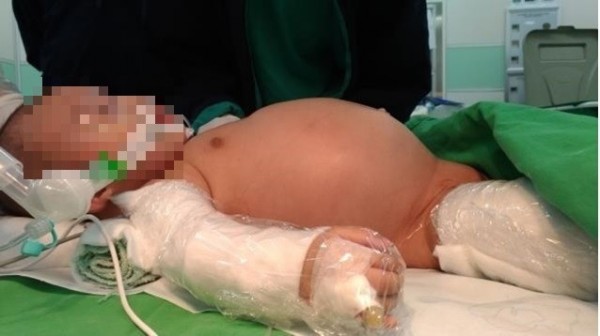 一名3個月大男嬰因腹脹、嘔吐、食慾不振,到醫院檢查發現胃部長了直徑約14公分大的畸胎瘤。(記者吳亮儀翻攝)