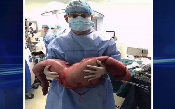 一名男子罹患「先天性巨大結腸症」導致嚴重便秘,近日他接受手術,醫師從他腹中取出長76公分的巨大「屎腸」,裏頭裝滿了15公斤的排泄物。(圖截自YouTube)