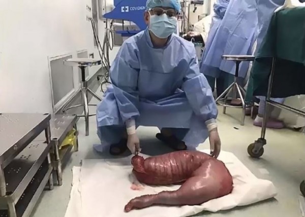 歷經3個小時的外科手術後,醫生從患者腹部取出長約76公分的腸子,裏頭全部包著排泄物,秤重後發現竟重達15公斤,畫面相當驚人。(圖截自YouTube)