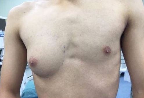 19歲的小楊長年受單側乳腺異常發育所苦。(擷取自《錢江晚報》)