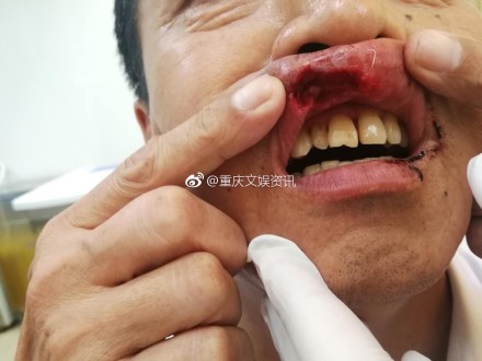 被攻击的乘客嘴唇遭咬伤。(图撷取自重庆文娱资讯微博)