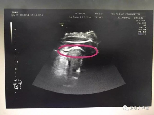 孕婦的超音波。(圖取自中國新聞網)