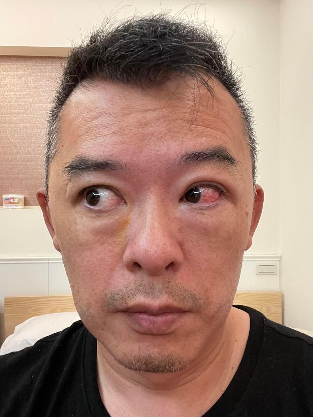Andy老爹雙腿眼角膜受損。(圖/Andy老爹FB)