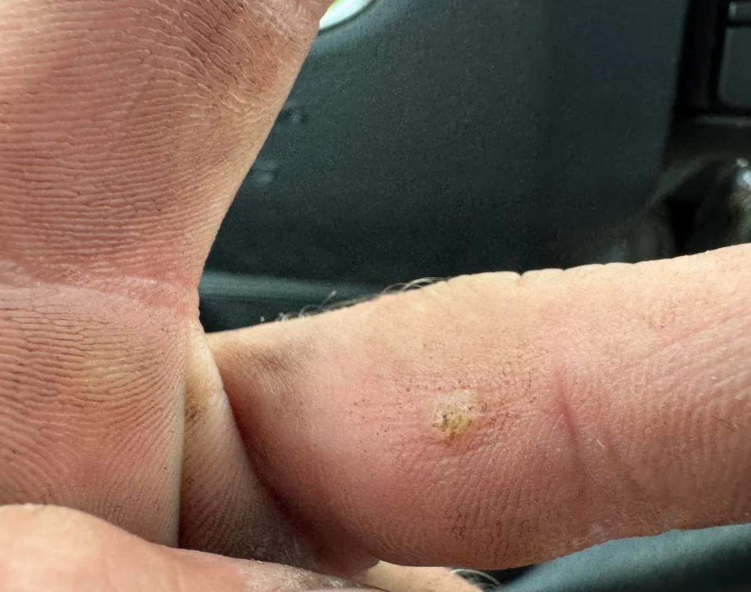 自己的手上也被燙出水泡。（圖／Reddit）