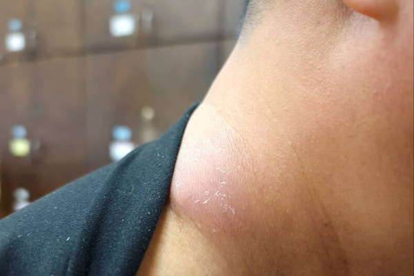 「只是落枕」變深頸部感染 一顆膿包差點奪命的真相