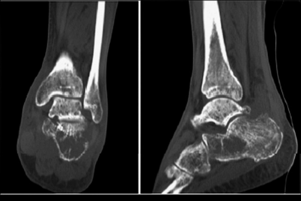 8旬翁足跟腫痛治不好 竟是極罕見「跟骨多發性骨髓瘤 」
