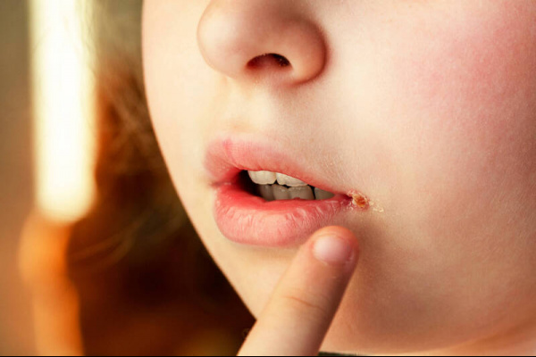 嘴角破、腳跟裂、脖子變黑？ 百萬網紅醫：多半不是缺營養