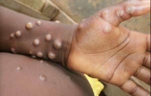 英國現猴痘社區感染 個案無西非旅行史